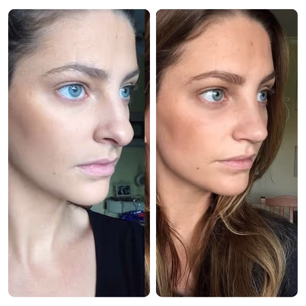 Nose Aesthetics (Rhinoplasty) in Turkey